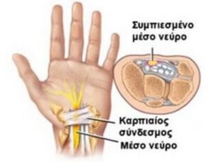 Η ιατρική χρήση της Κάνναβης και το Σύνδρομο Καρπιαίου Σωλήνα
