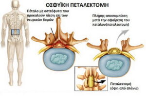 Η ιατρική χρήση της Κάνναβης και το Σύνδρομο Πεταλεκτομίας με Χρόνια Ριζοπάθεια