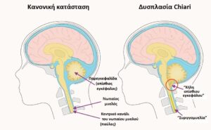 Η ιατρική χρήση της Κάνναβης και η Δυσπλασία Arnold-Chiari