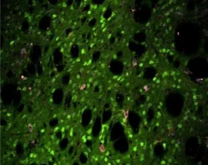 Κάνναβη και Σύνδρομο Tourette